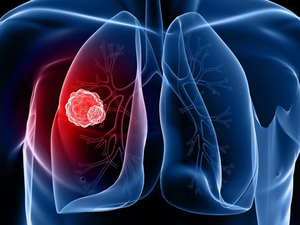 lung cancer